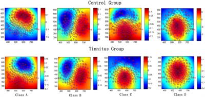 Deviant Dynamics of Resting State Electroencephalogram Microstate in Patients With Subjective Tinnitus